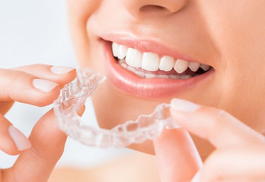 Invisalign: London’s Preferred Choice for a Straighter Smile
